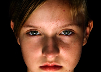 Acne.jpg