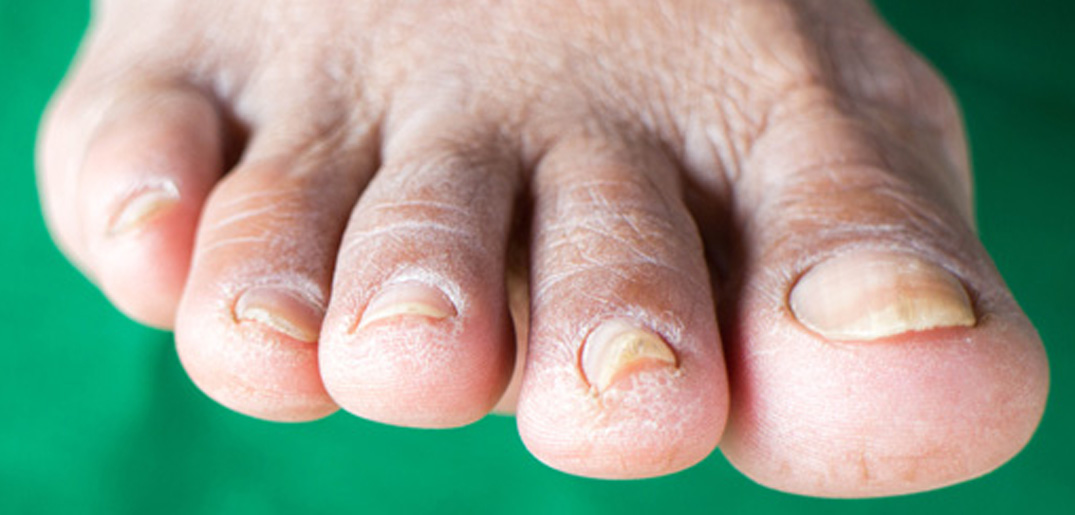 diabetic foot_s.jpg