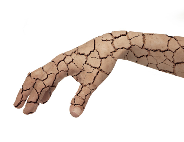 cracked skin hand_s.jpg