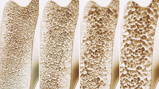 osteoporosis.jpg